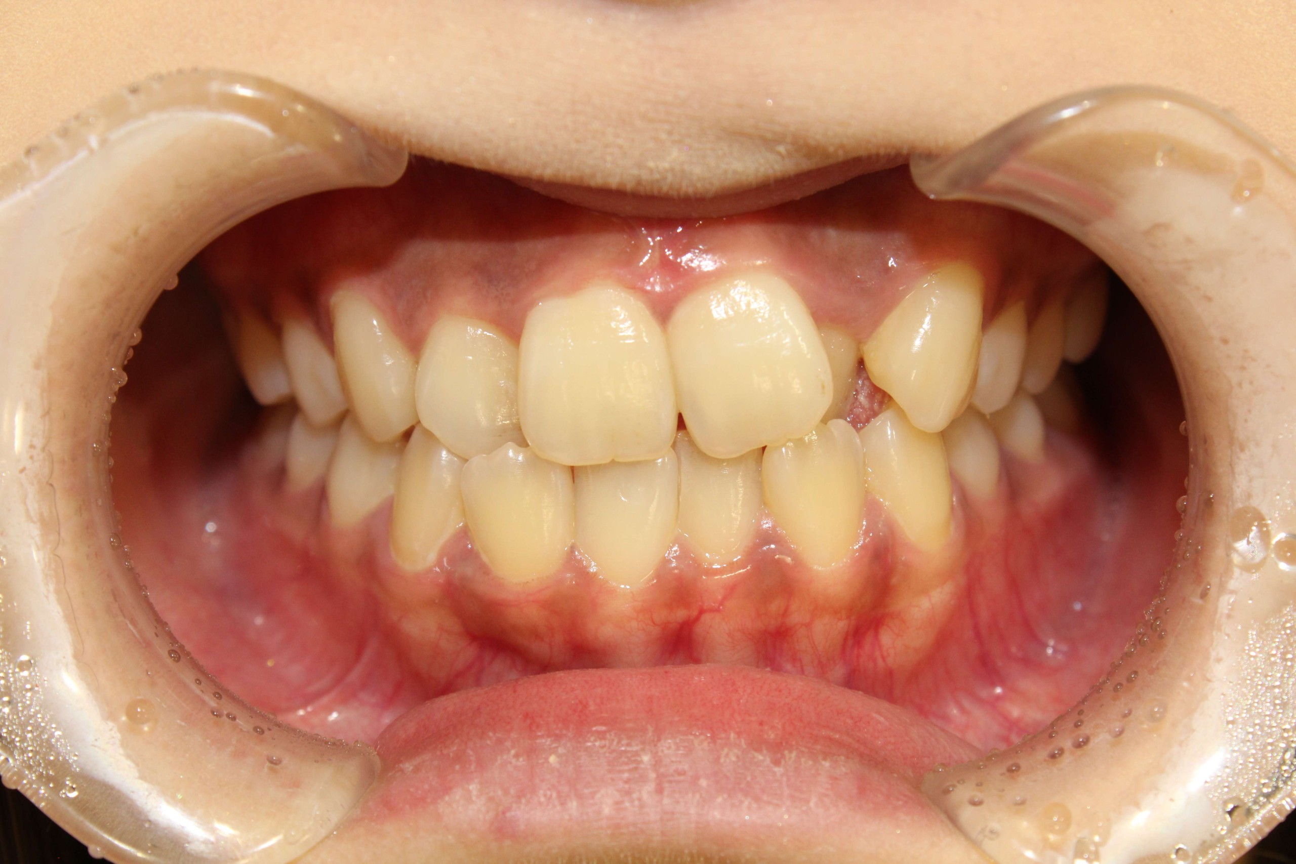 歯のでこぼこ・裏側矯正の症例