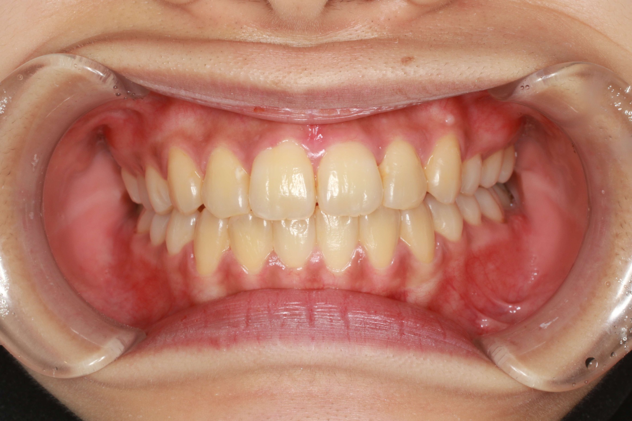 歯のでこぼこ・裏側矯正の症例