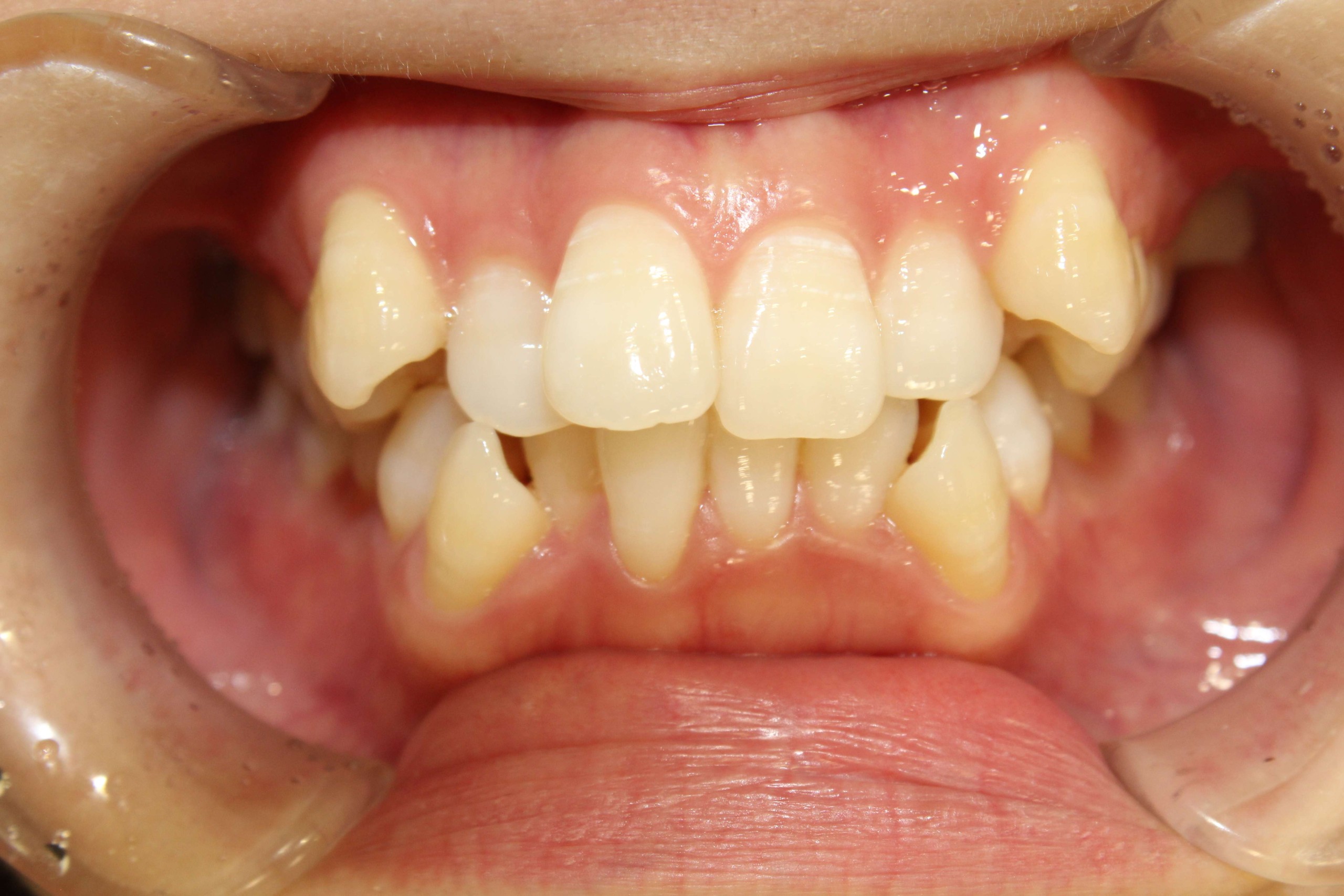 でこぼこ・リンガルの症例