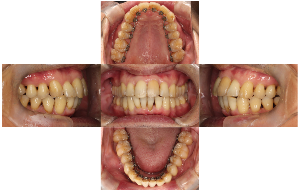 上の歯が出ている、裏側矯正の症例