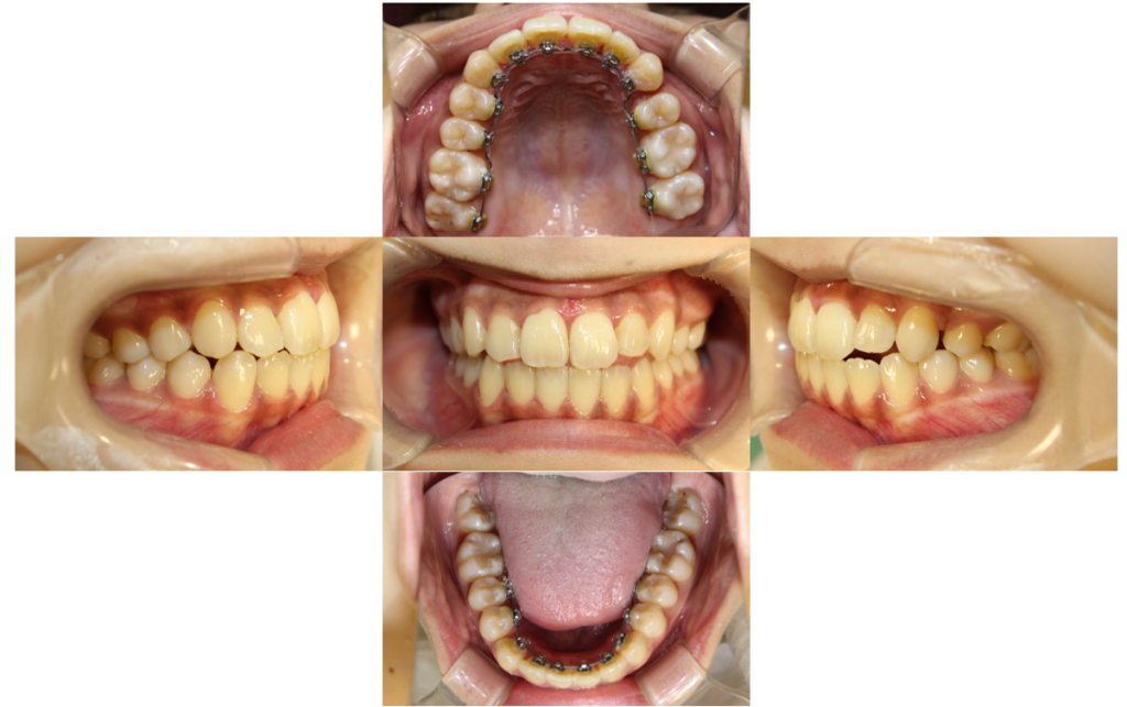 歯のでこぼこ・裏側矯正の症例