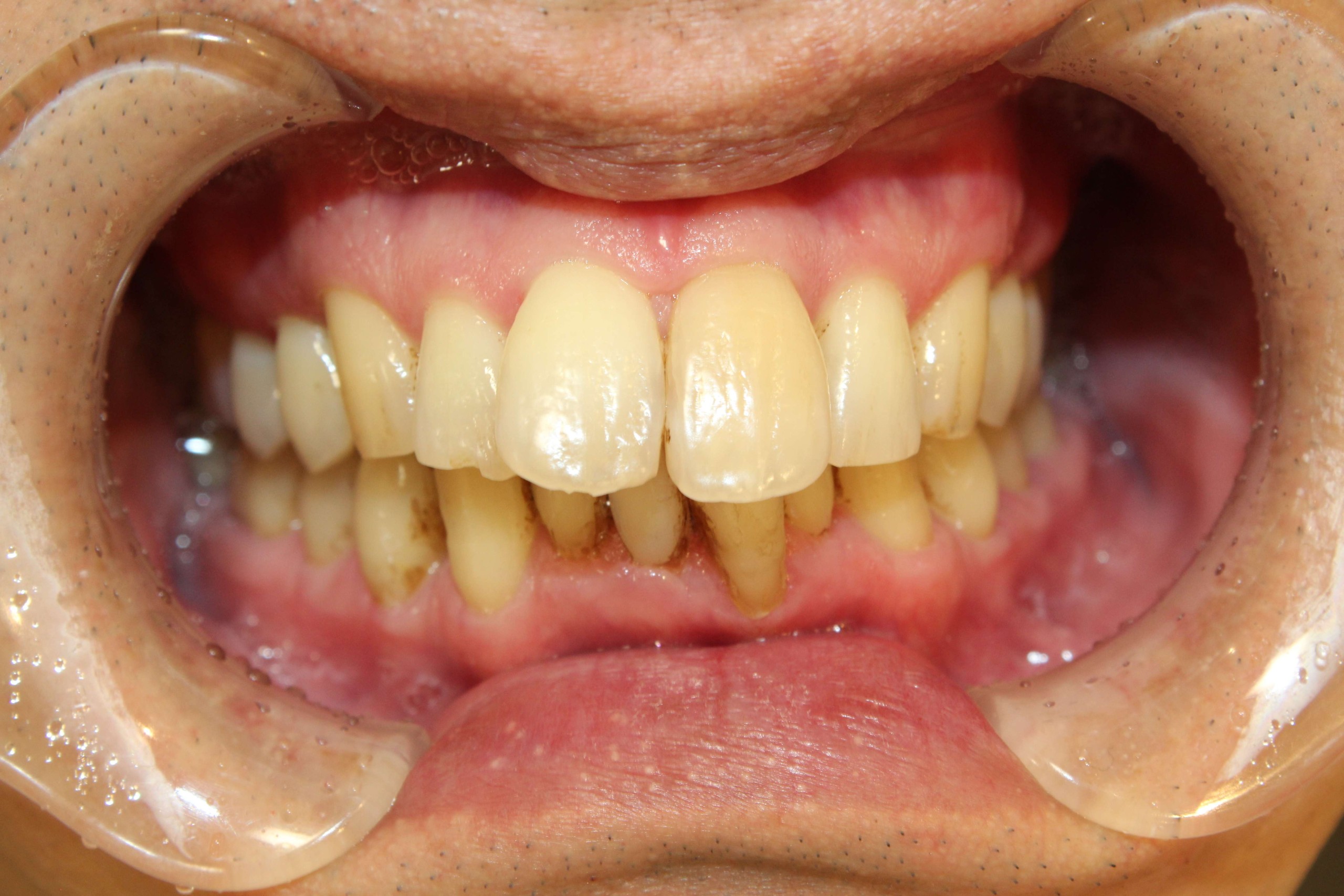 上の歯が出ている、裏側矯正の症例