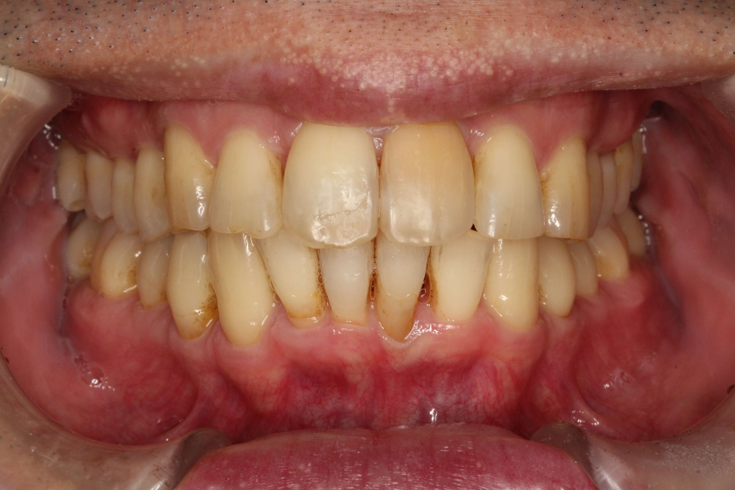 上の歯が出ている、裏側矯正の症例
