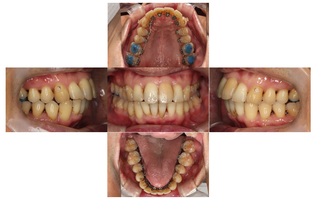上の歯が出ている、裏側矯正の症例