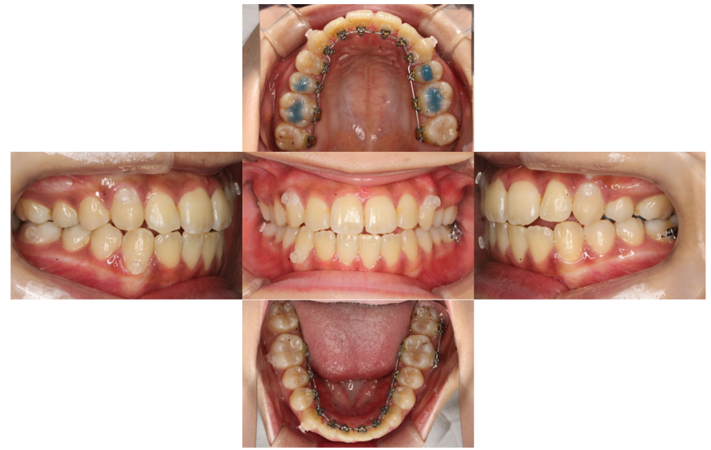 歯のでこぼこ・裏側矯正の症例