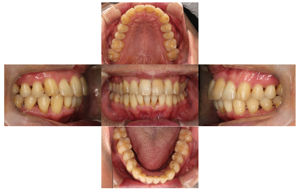 上の歯が出ている、裏側矯正の症例