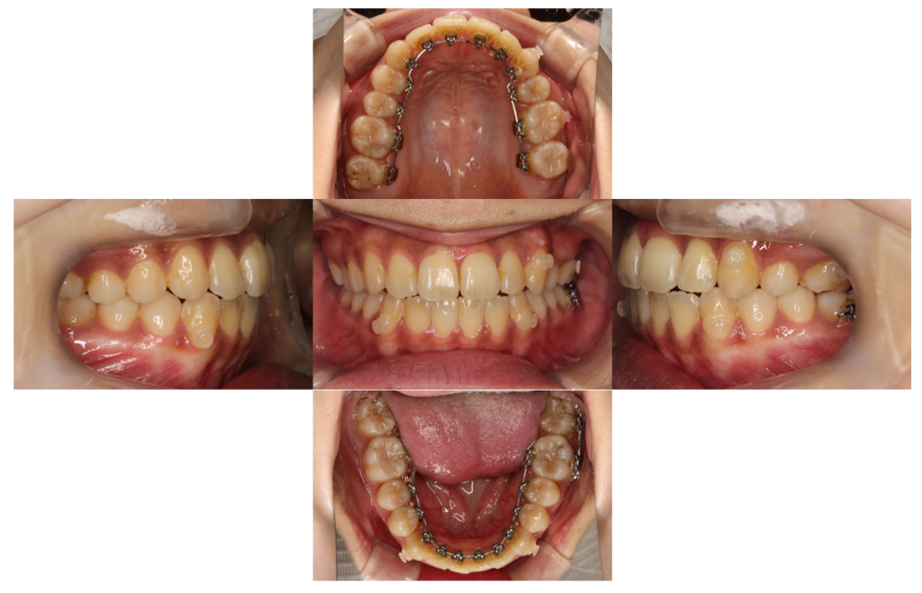 歯のでこぼこ・裏側矯正の症例