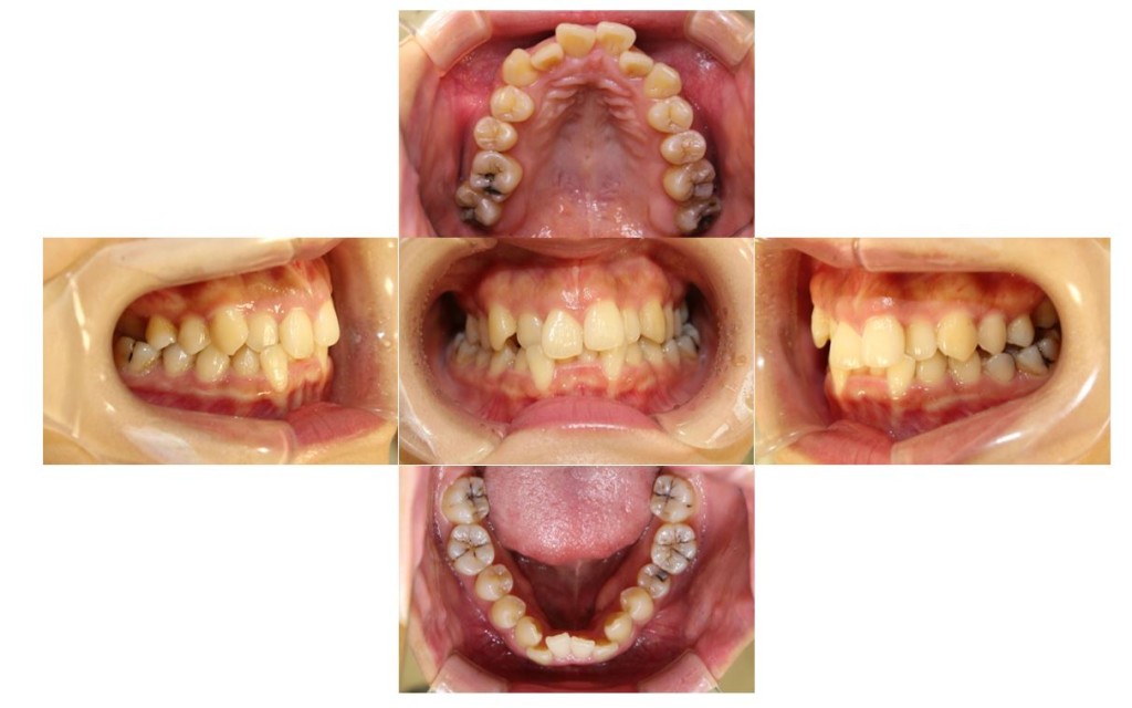 でこぼこ・噛み合わせが深いリンガルの症例