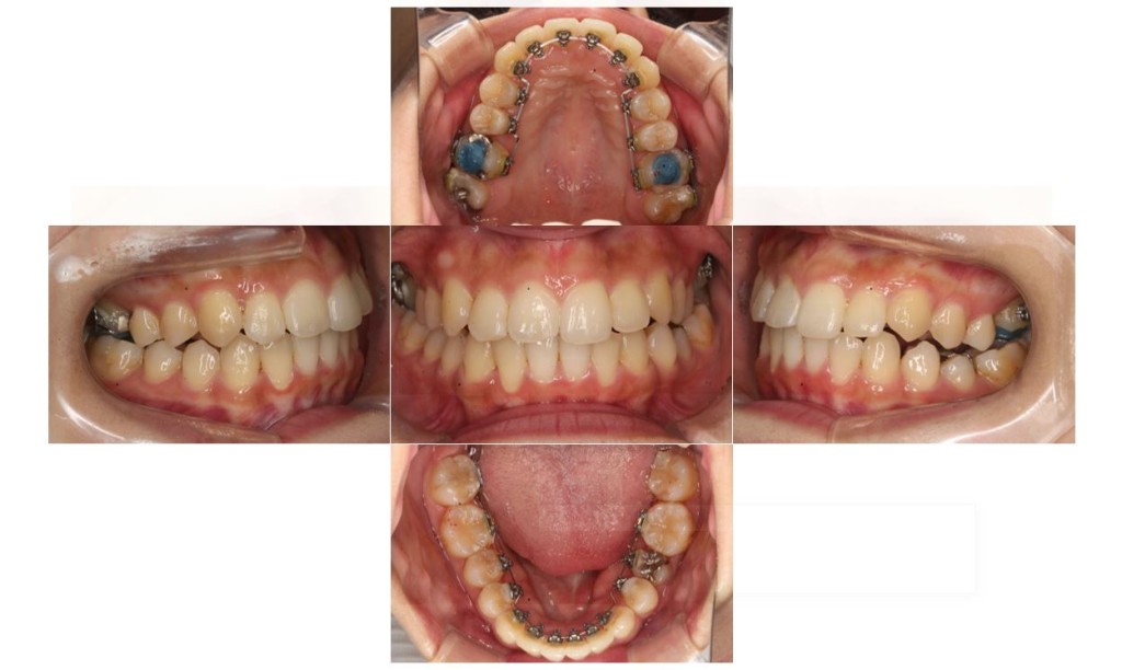でこぼこ・噛み合わせが深いリンガルの症例