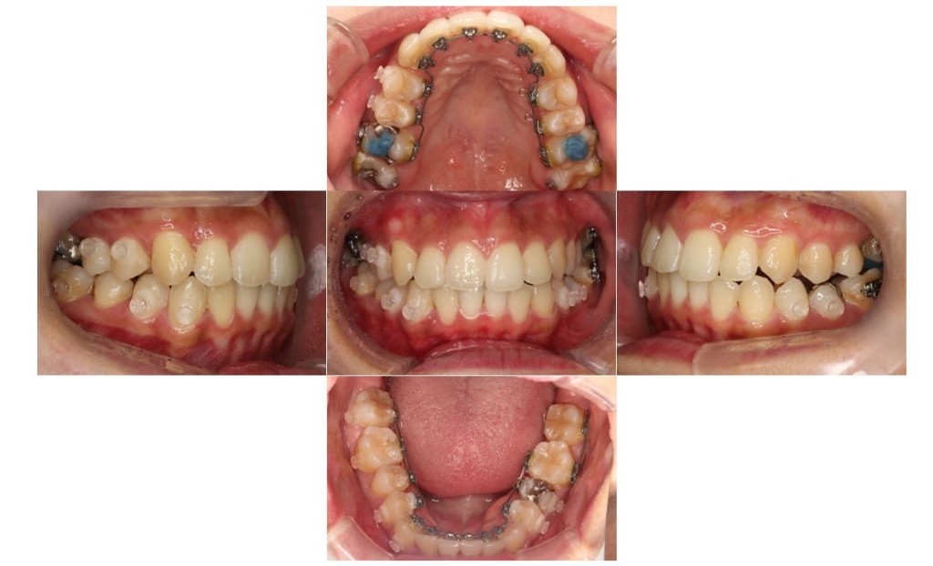 でこぼこ・噛み合わせが深いリンガルの症例