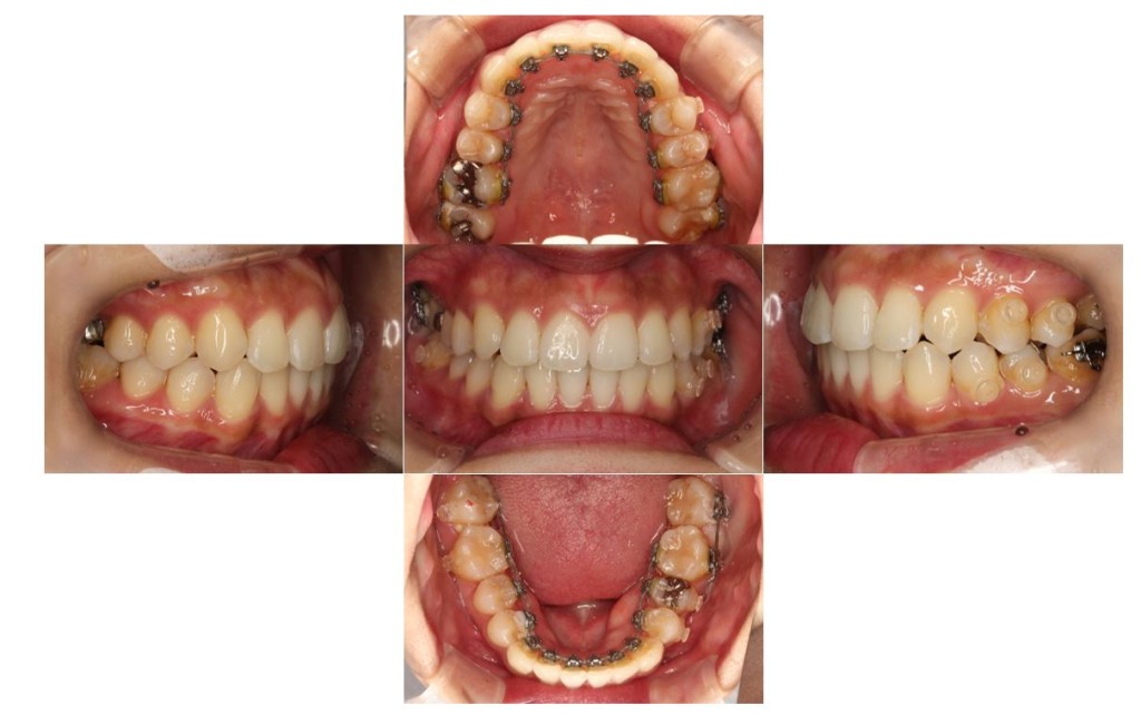 でこぼこ・噛み合わせが深いリンガルの症例