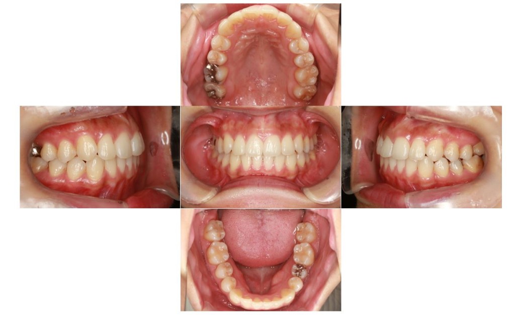 でこぼこ・噛み合わせが深いリンガルの症例