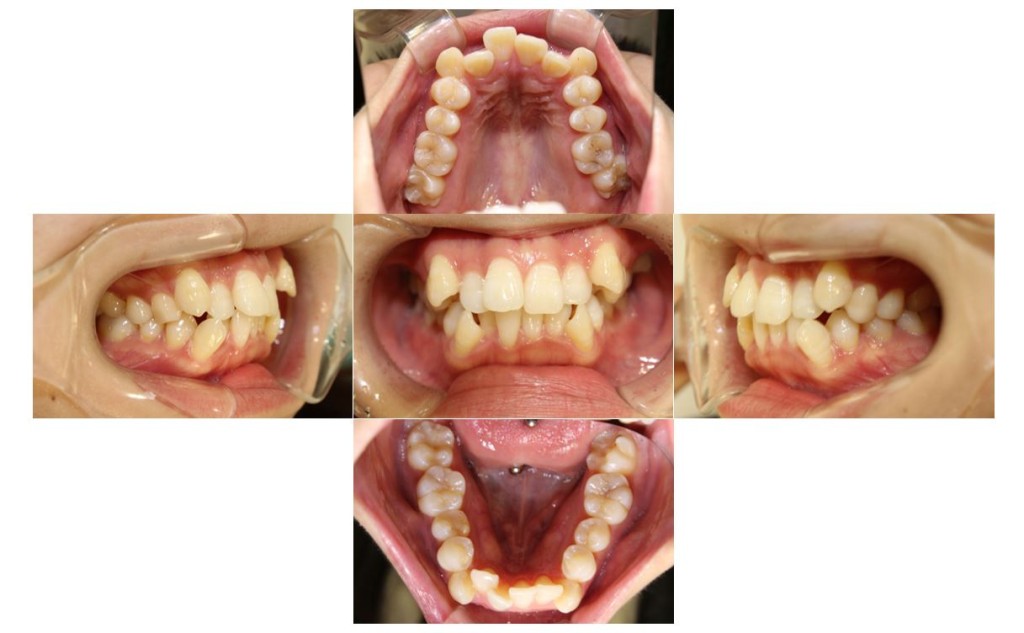 でこぼこ・リンガルの症例