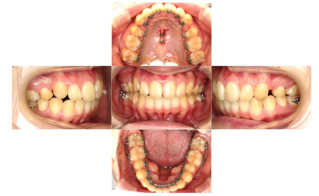 でこぼこ・リンガルの症例