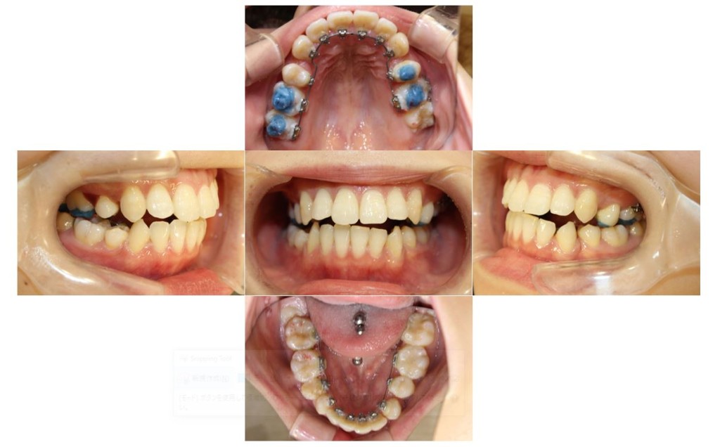 でこぼこ・リンガルの症例