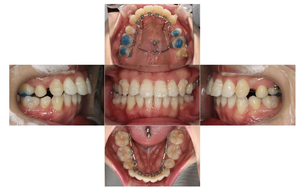 でこぼこ・リンガルの症例