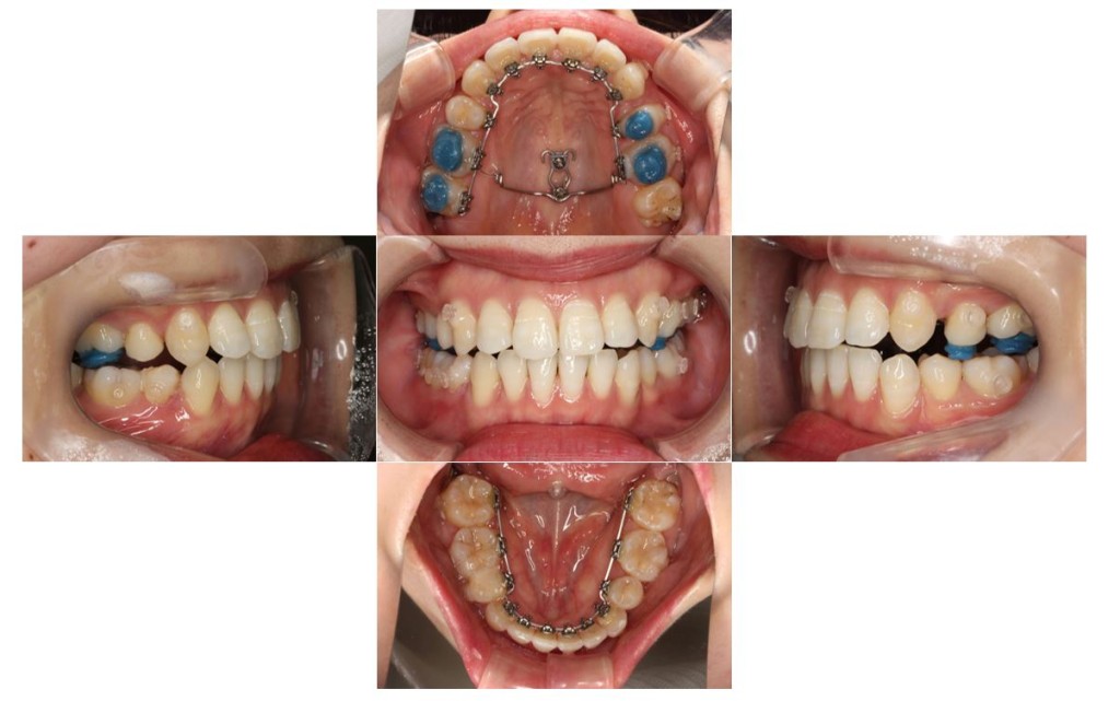 でこぼこ・リンガルの症例