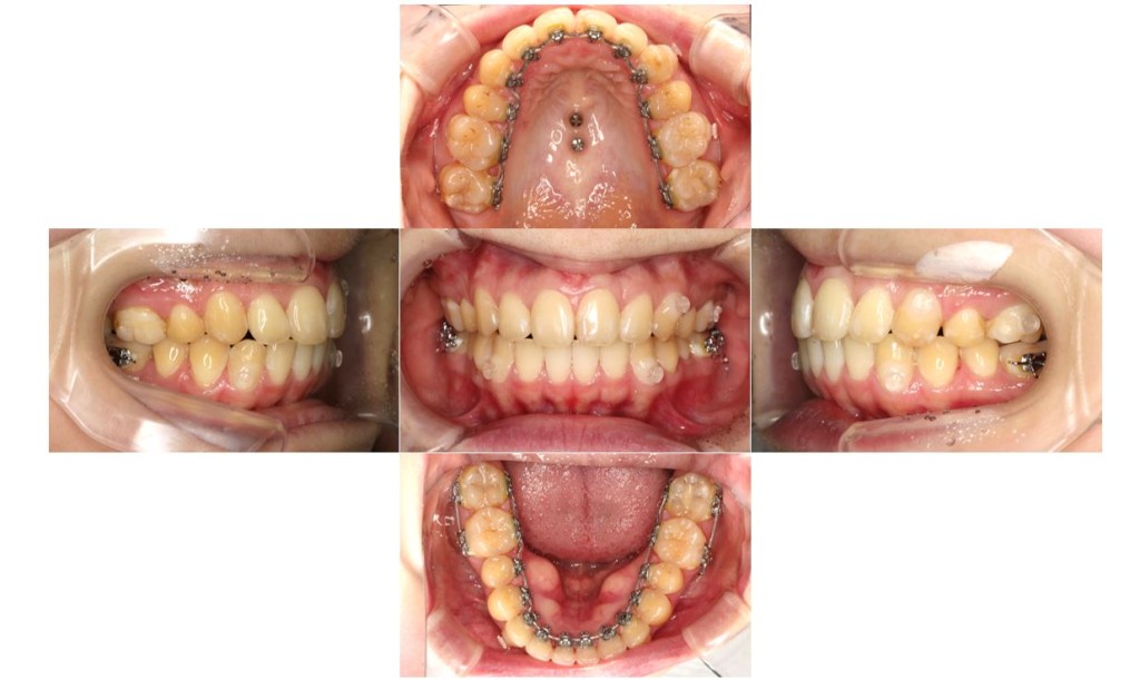 でこぼこ・リンガルの症例