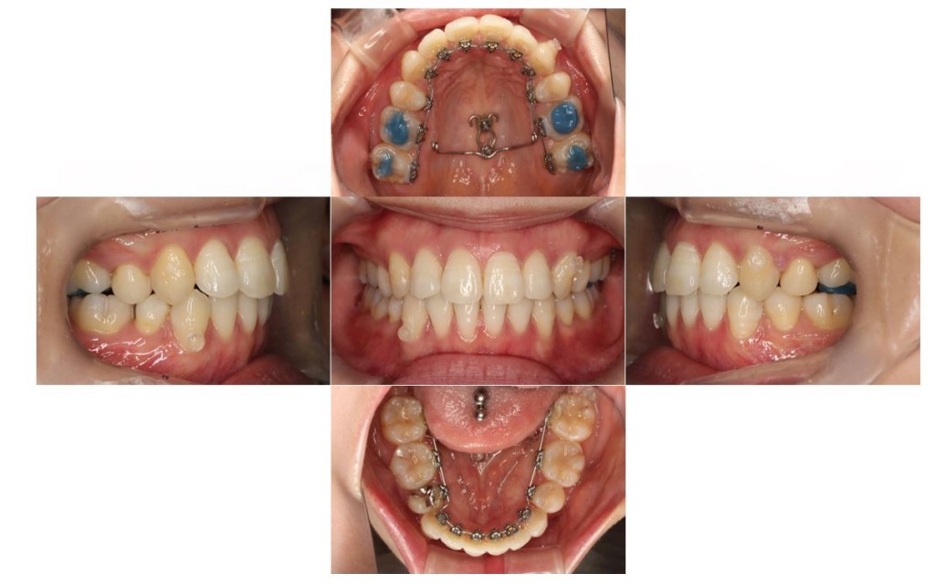 でこぼこ・リンガルの症例