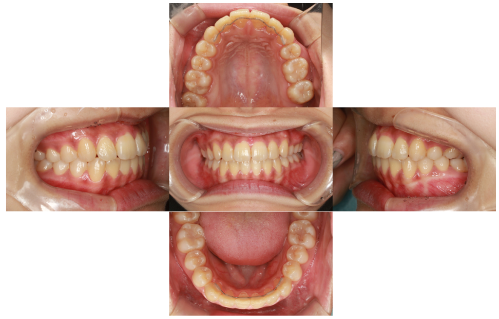 歯のでこぼこ・裏側矯正の症例