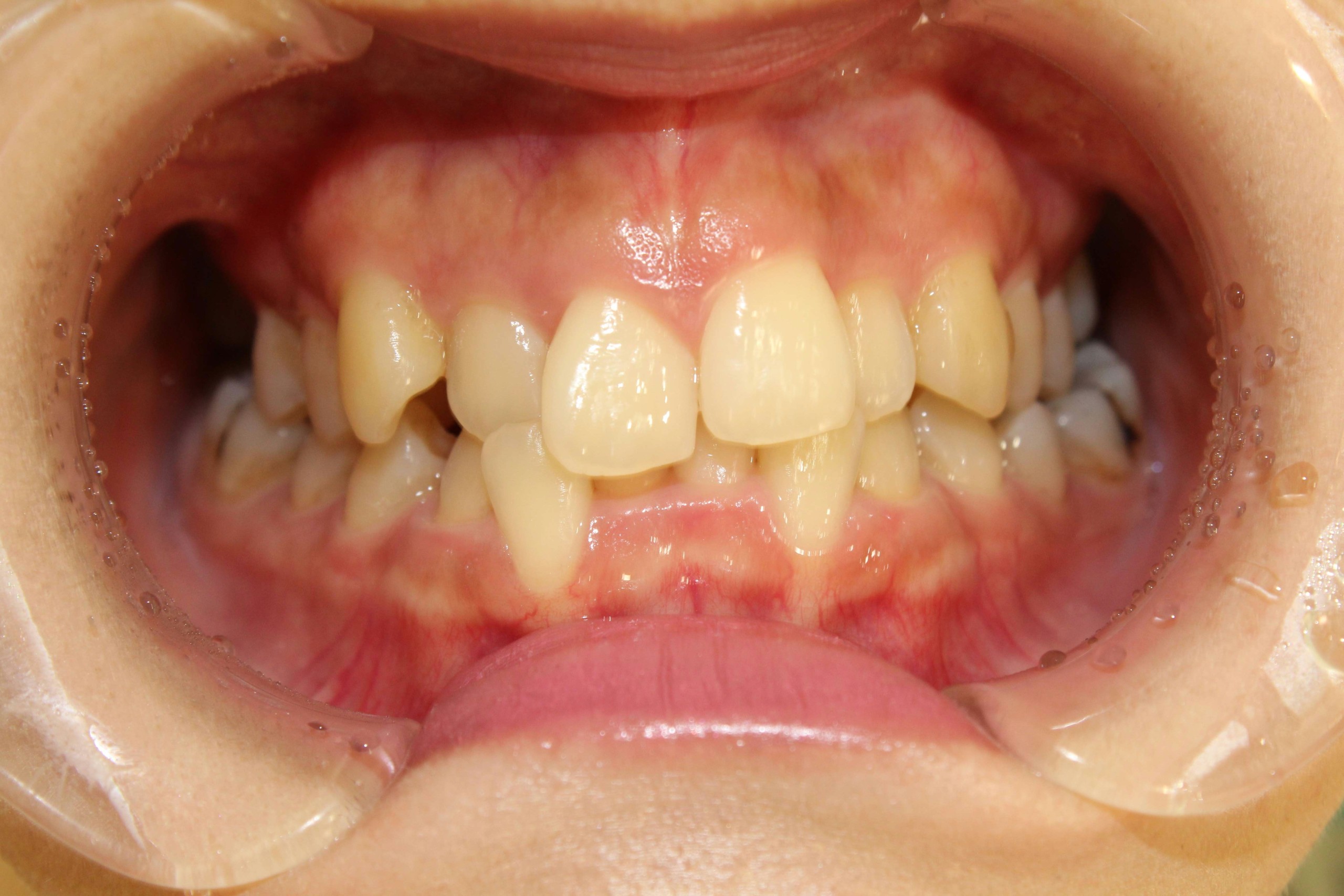 でこぼこ・噛み合わせが深いリンガルの症例