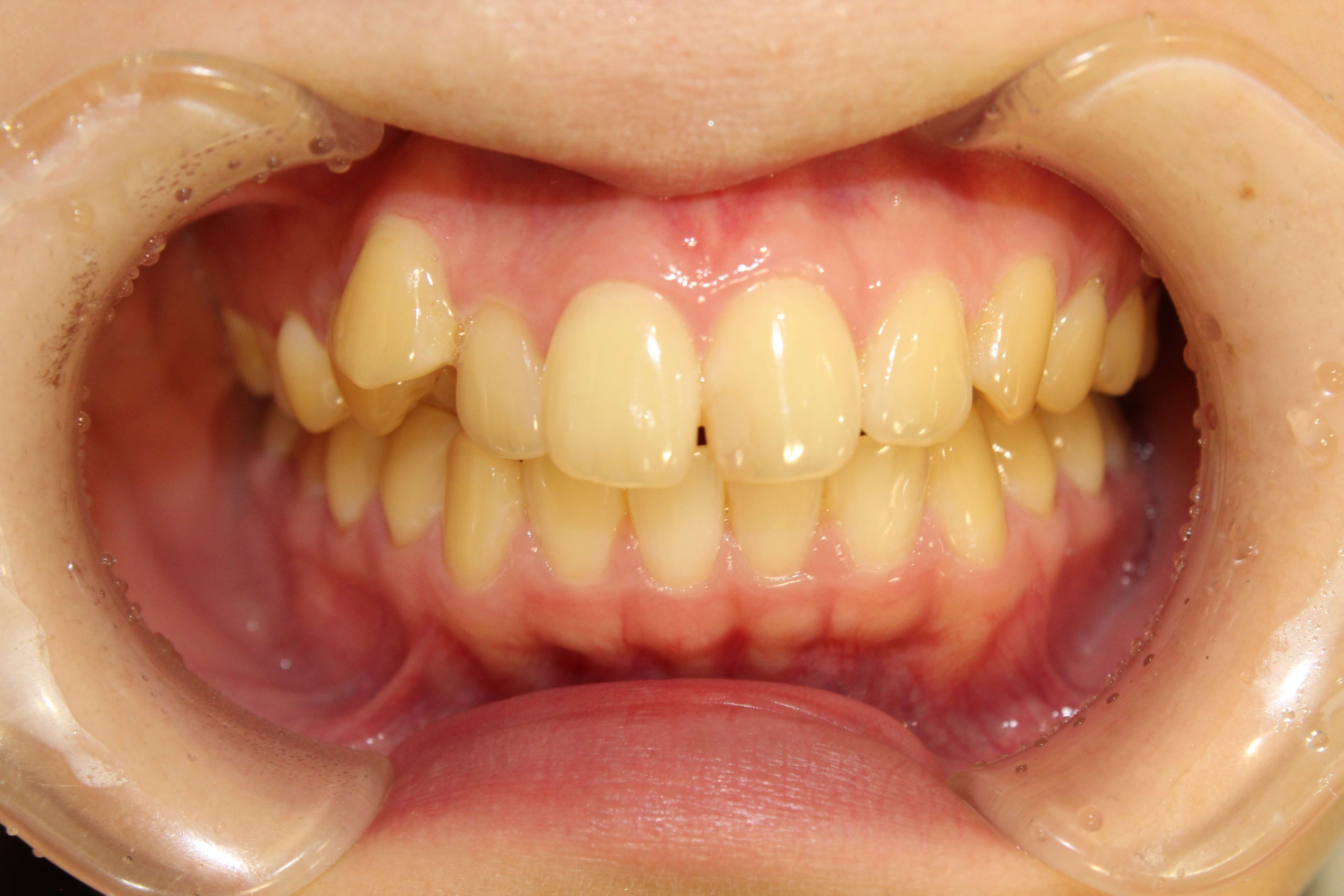 でこぼこ・リンガルの症例