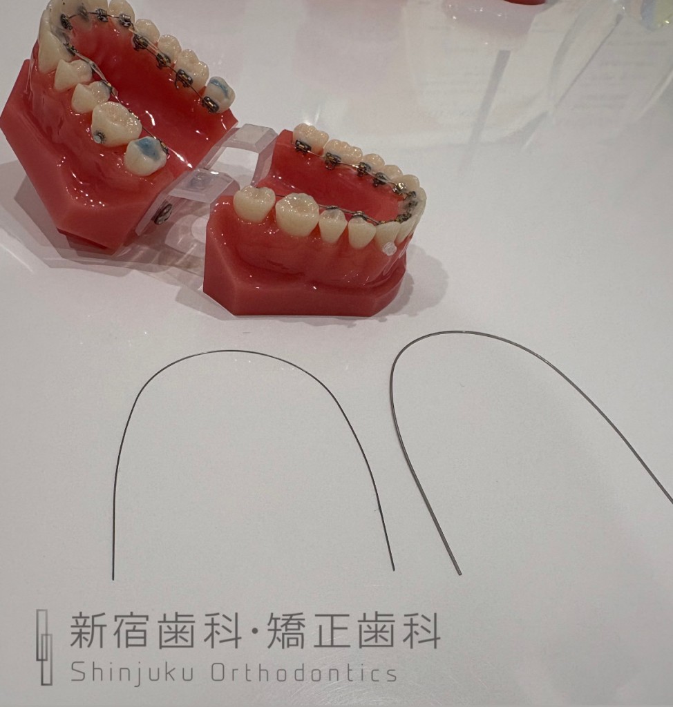 ワイヤー矯正の治療について　細いワイヤーから太いワイヤーへ調整のたびに変えていく