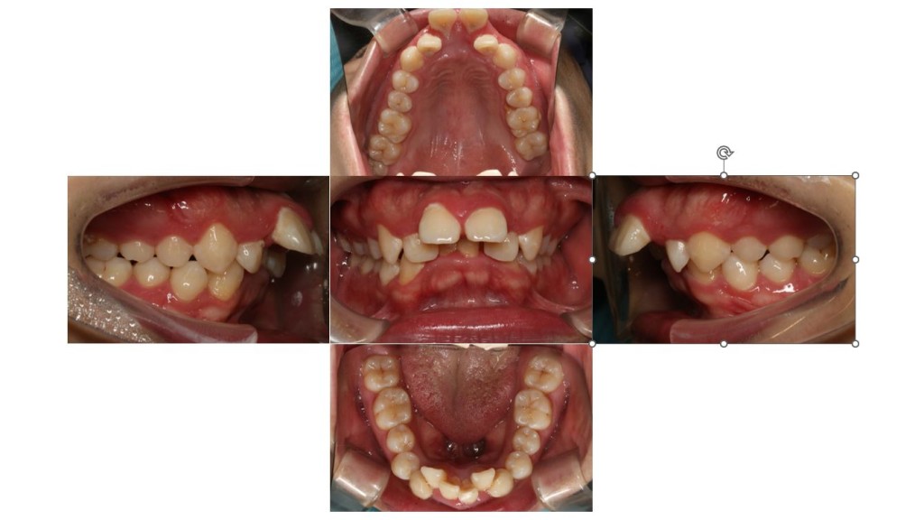 上の歯が出ている・表側矯正の症例