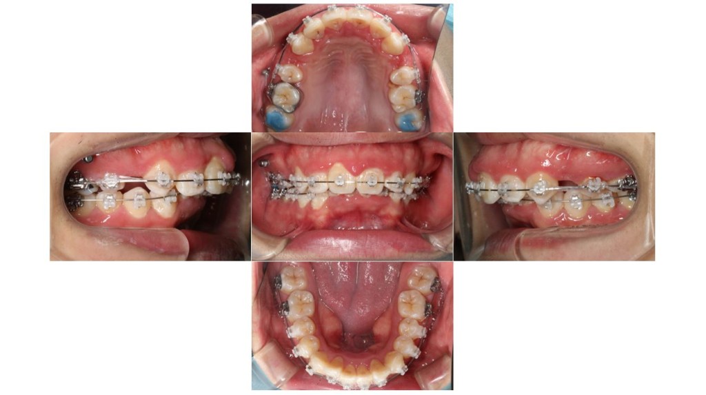 上の歯が出ている・表側矯正の症例