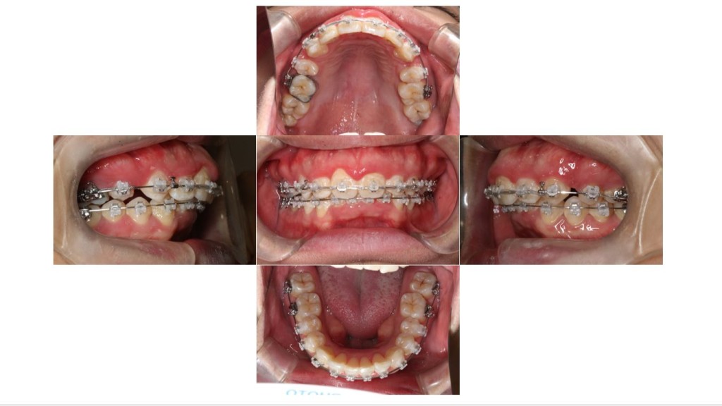 上の歯が出ている・表側矯正の症例