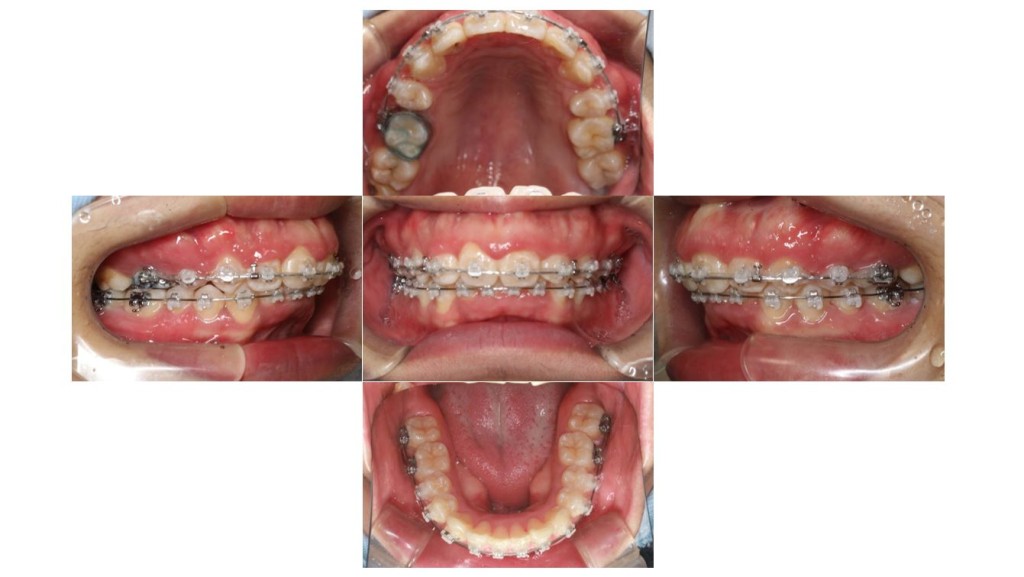 上の歯が出ている・表側矯正の症例