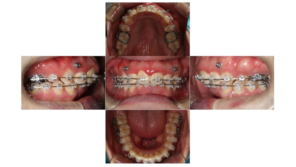 上の歯が出ている・表側矯正の症例