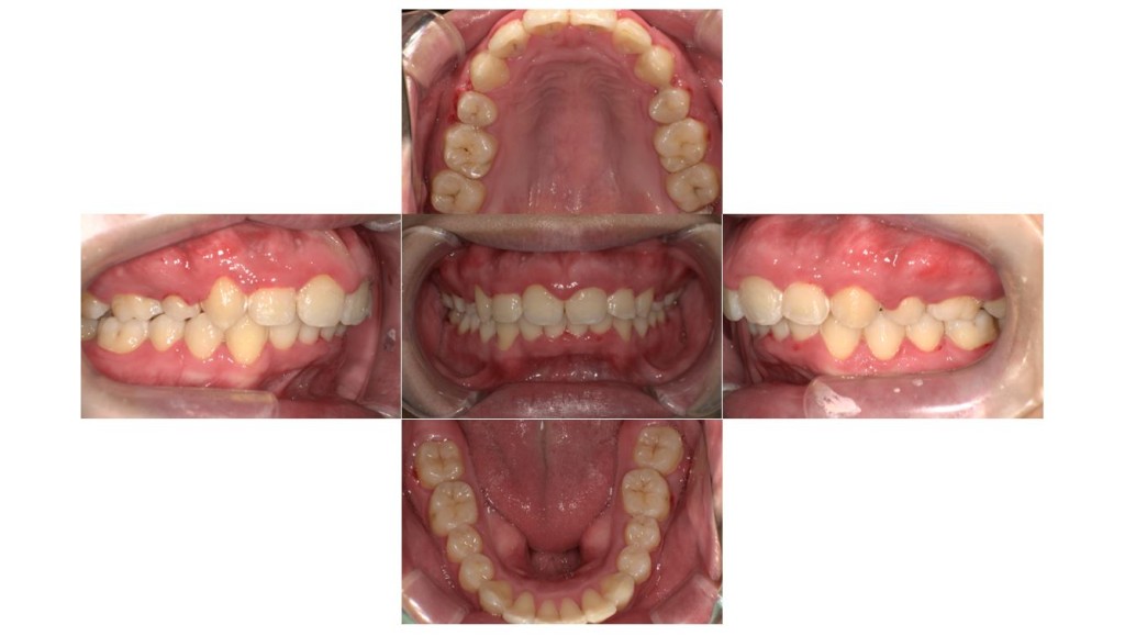 上の歯が出ている・表側矯正の症例