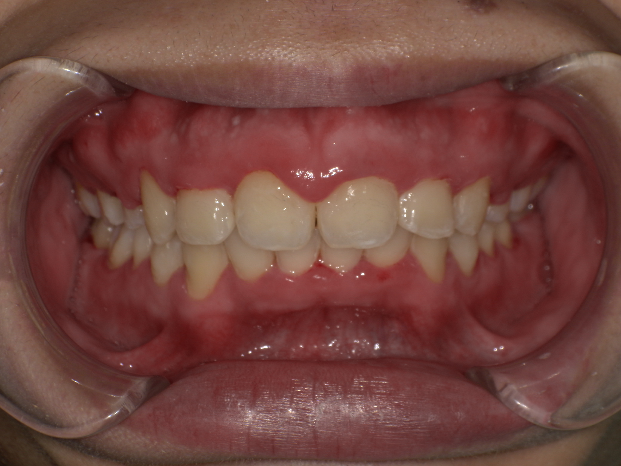 上の歯が出ている・表側矯正の症例