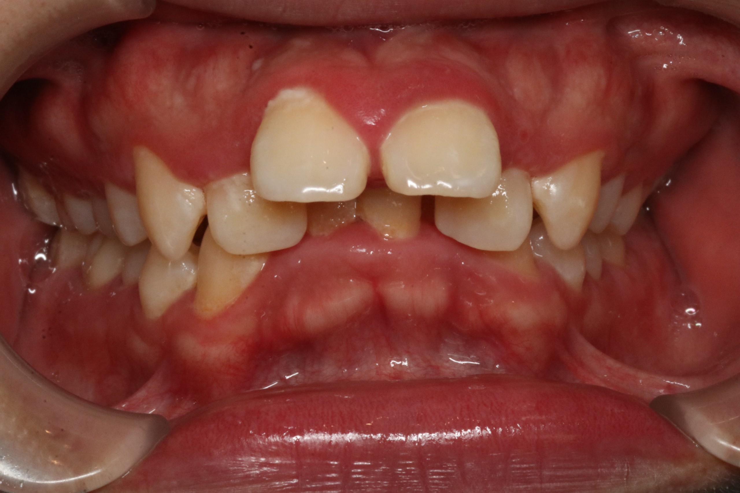 上の歯が出ている・表側矯正の症例