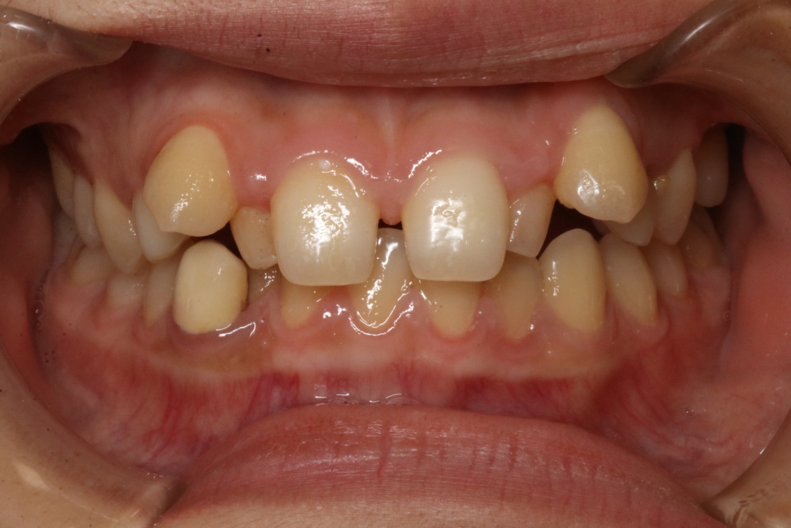 歯のでこぼこ・ハーフリンガルの症例