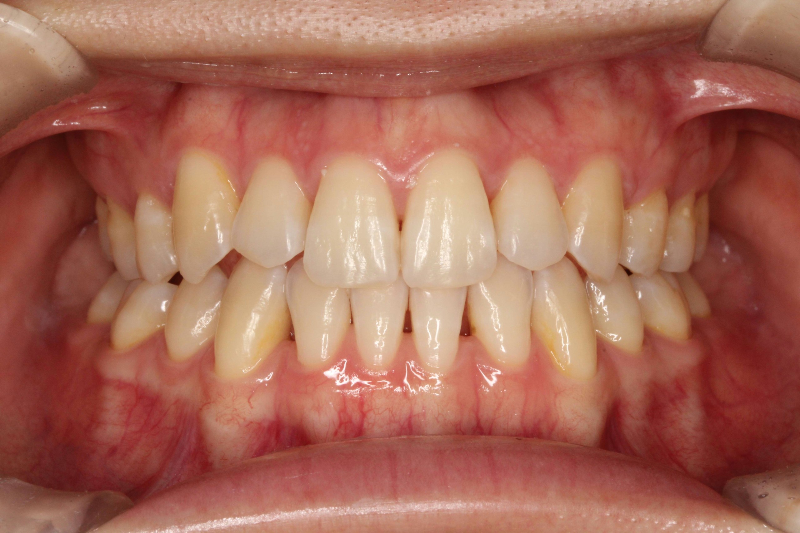 リンガル・受け口の症例