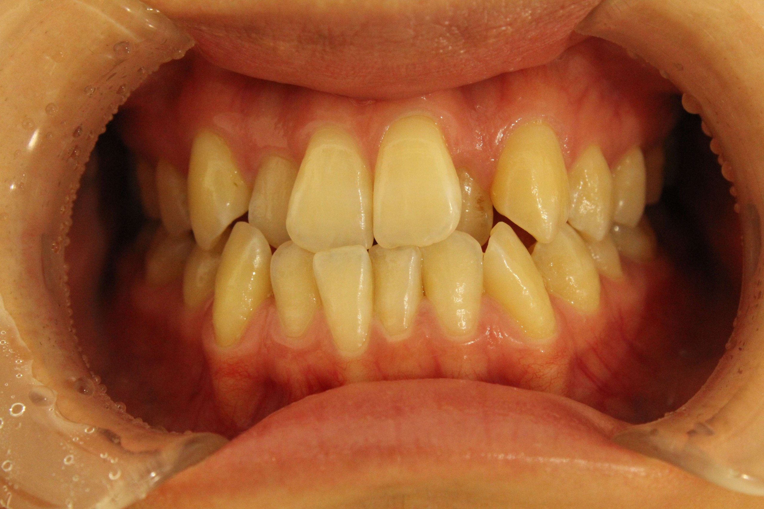 リンガル・受け口の症例