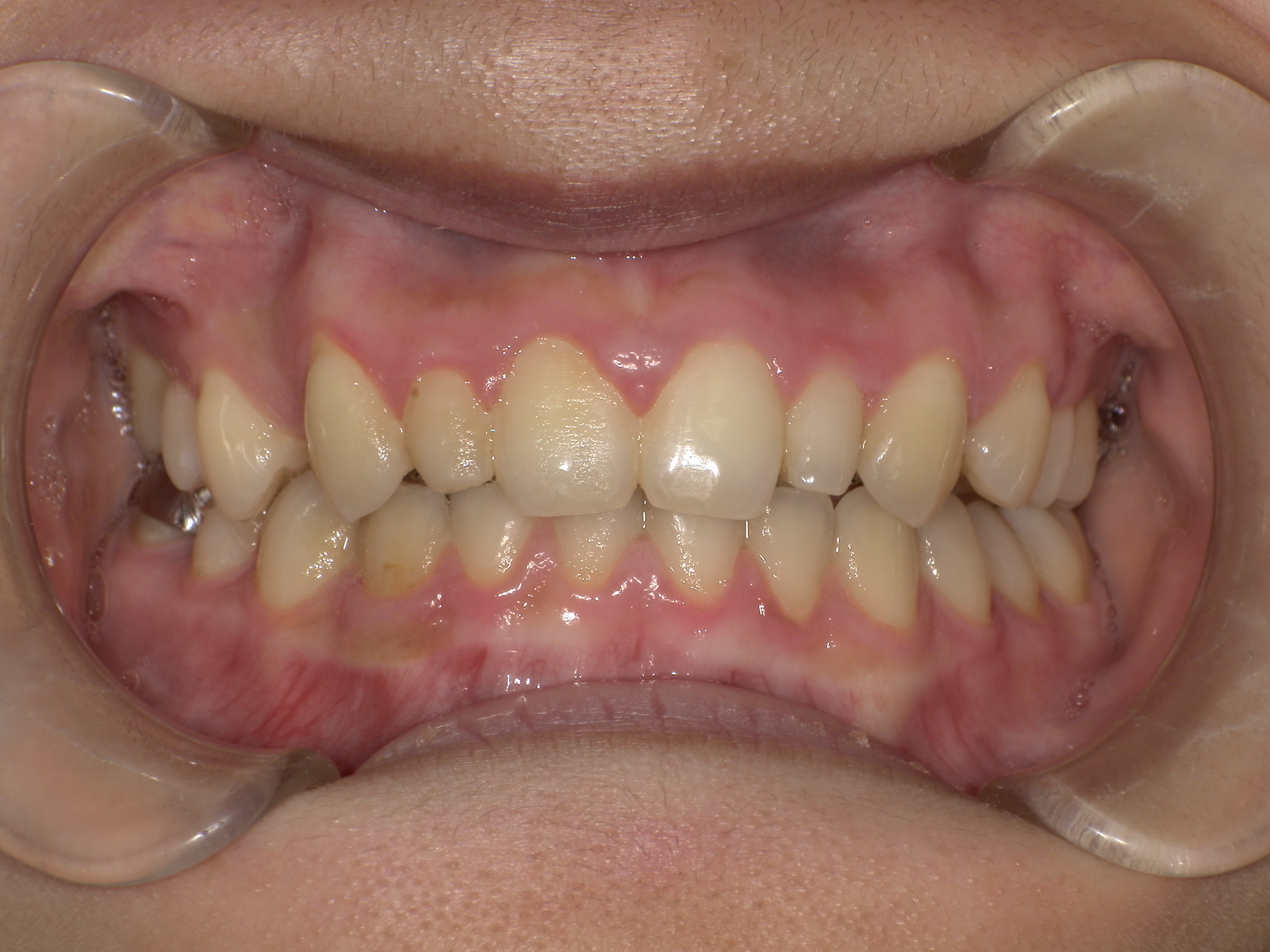 歯のでこぼこ・ハーフリンガルの症例