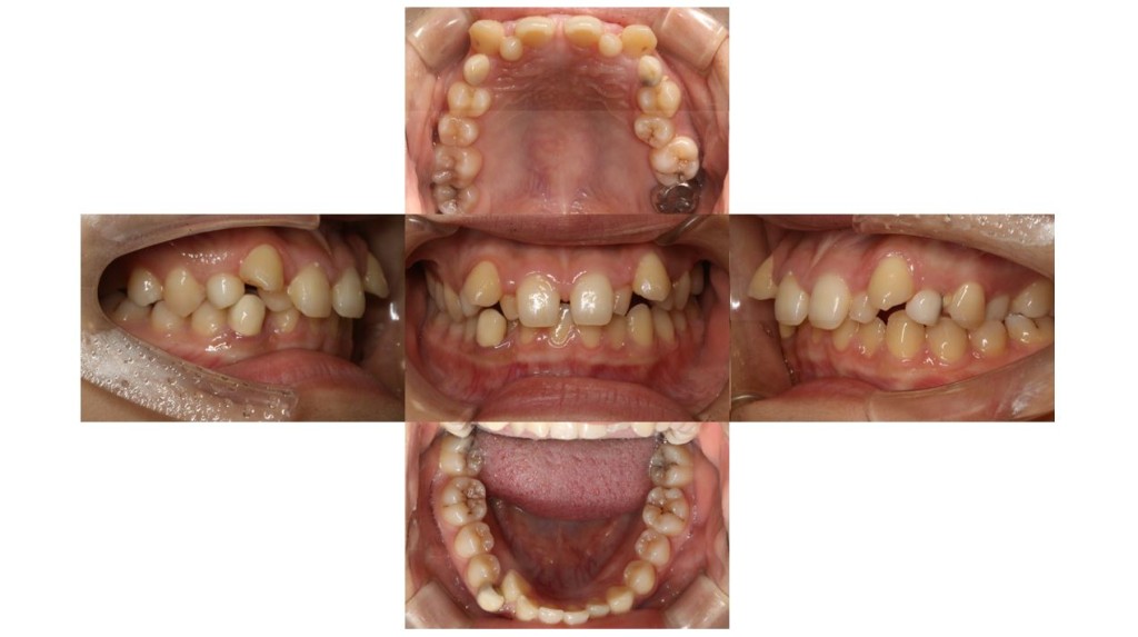 歯のでこぼこ・ハーフリンガルの症例