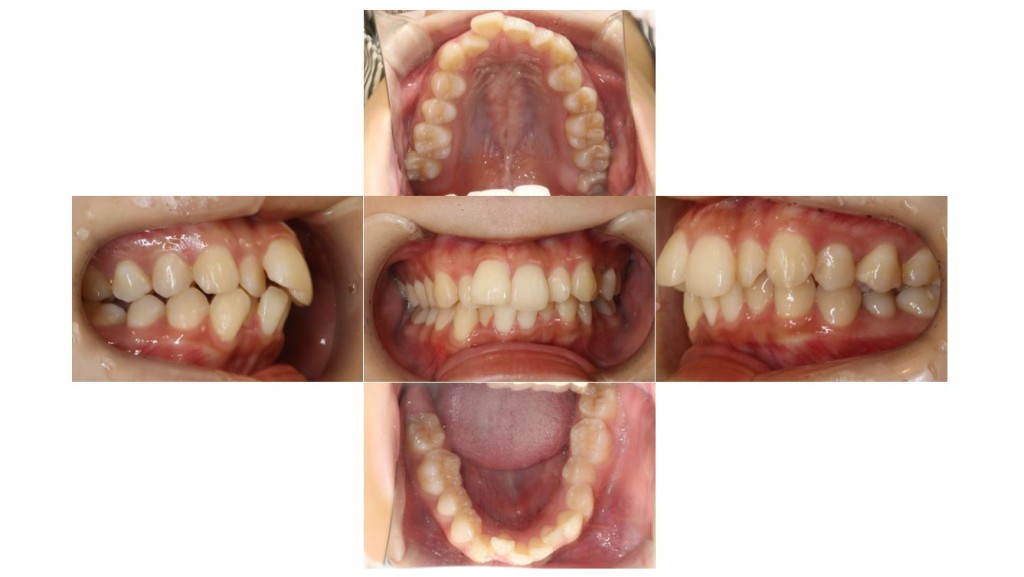 前歯のでこぼこ・表側矯正の症例