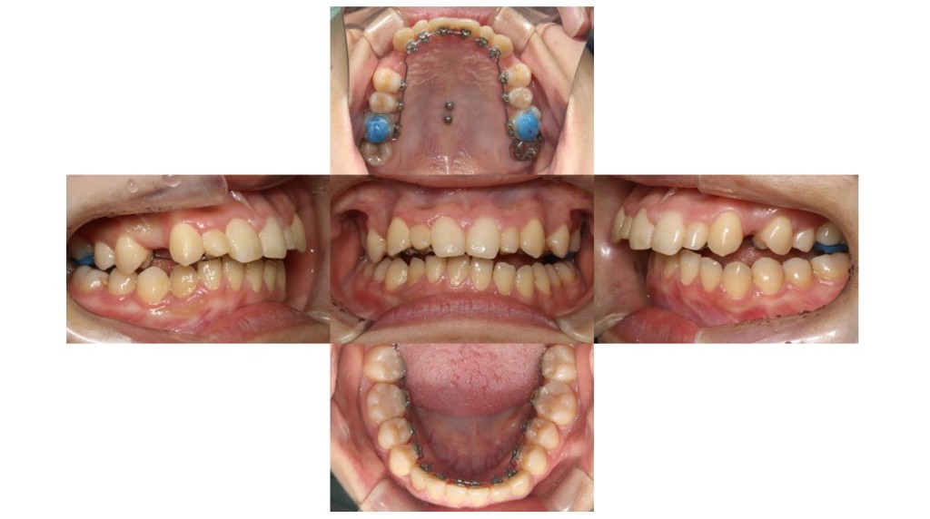 歯のでこぼこ・ハーフリンガルの症例