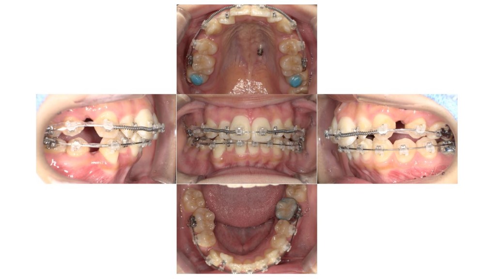 前歯のでこぼこ・表側矯正の症例