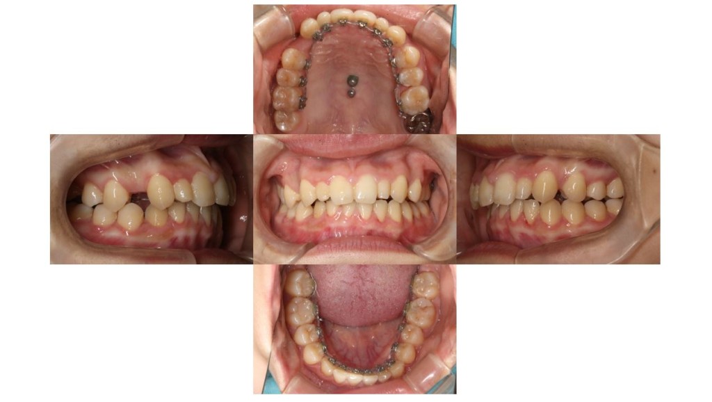 歯のでこぼこ・ハーフリンガルの症例