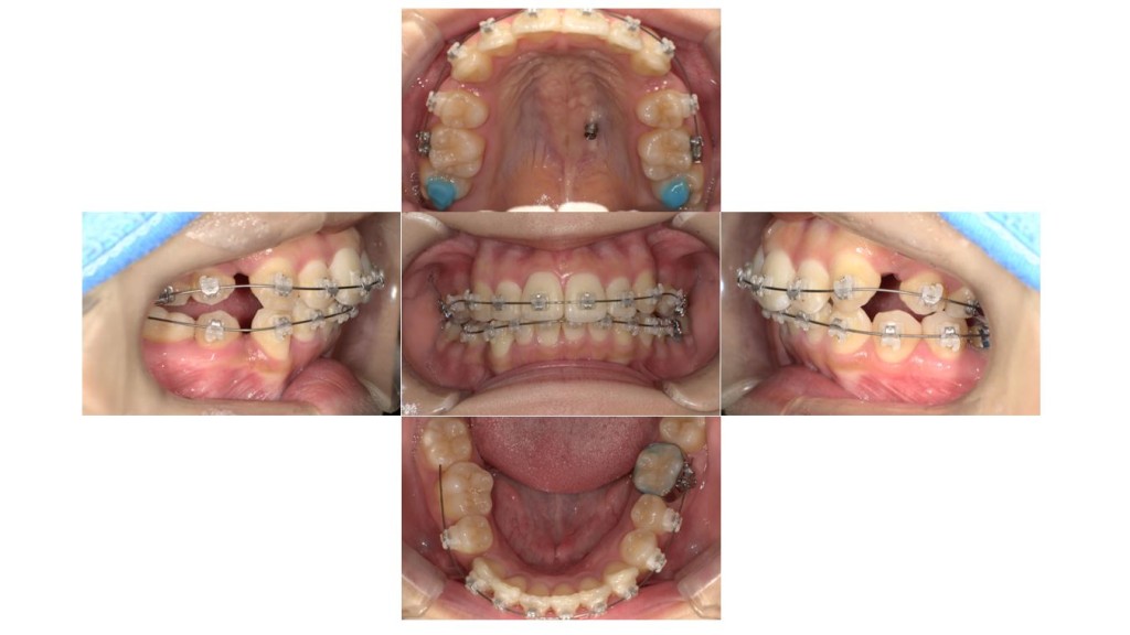 前歯のでこぼこ・表側矯正の症例