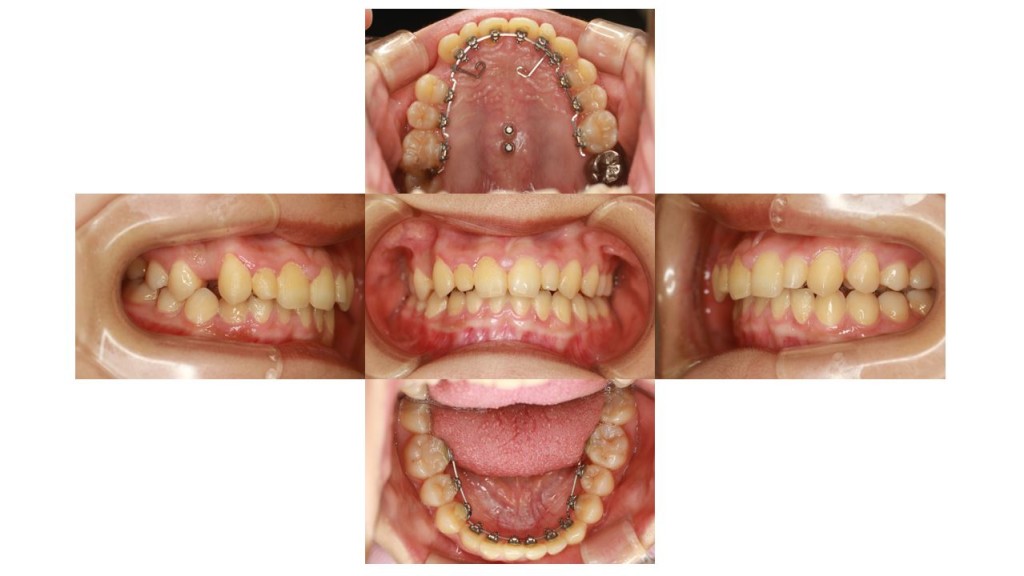 歯のでこぼこ・ハーフリンガルの症例