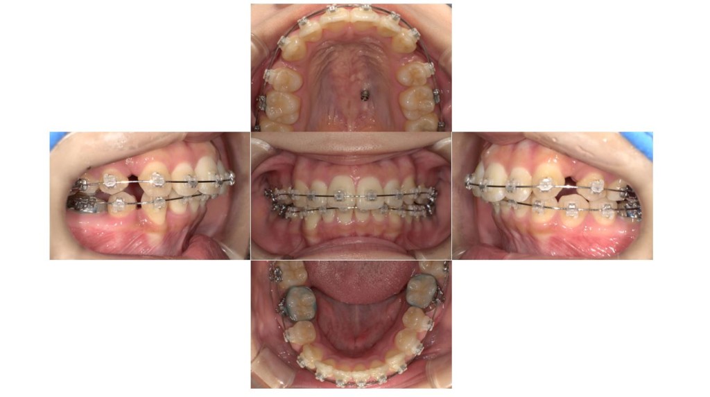 前歯のでこぼこ・表側矯正の症例