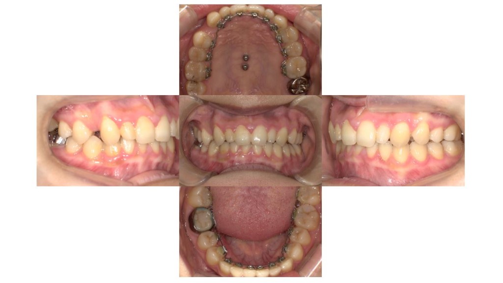 歯のでこぼこ・ハーフリンガルの症例