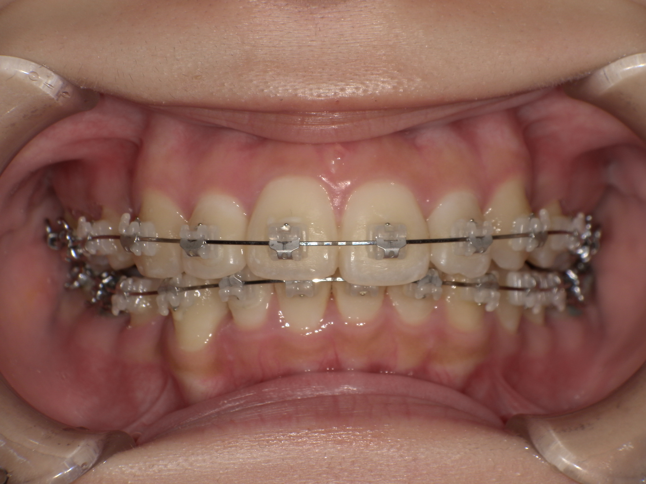 前歯のでこぼこ・表側矯正の症例