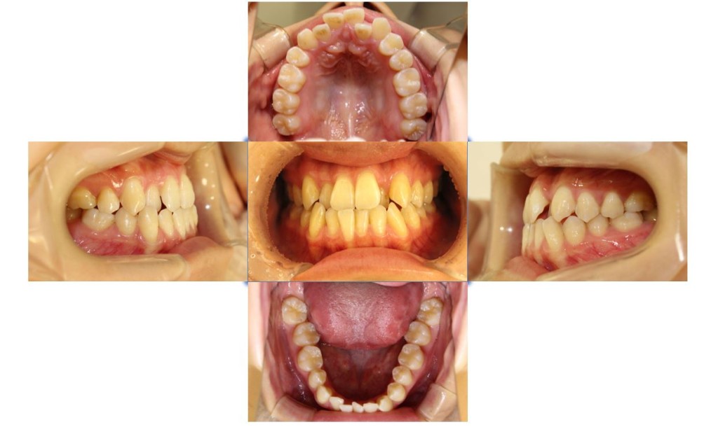 リンガル・受け口の症例